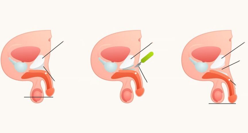 ligamentotomy សម្រាប់ការពង្រីកលិង្គ